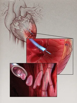 Ilustração de terapia de mioblastos para coração