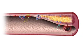 Blood clot formation illustration by Craig Foster