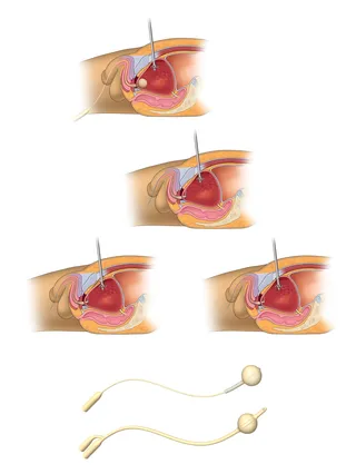 Uma ilustração de cirurgia de bexiga hr