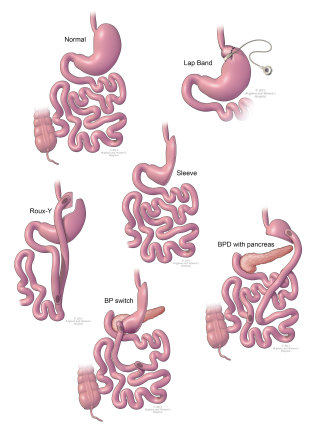 胃バイパス手術の手順の図解
