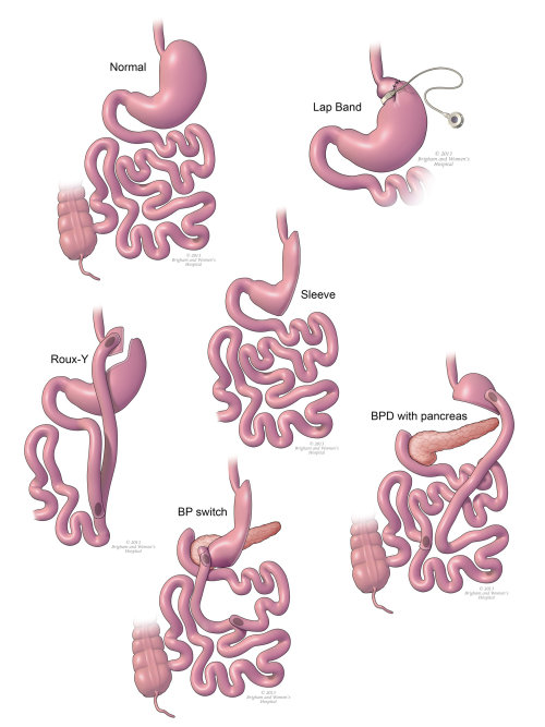 An illustration of gastric bypass process