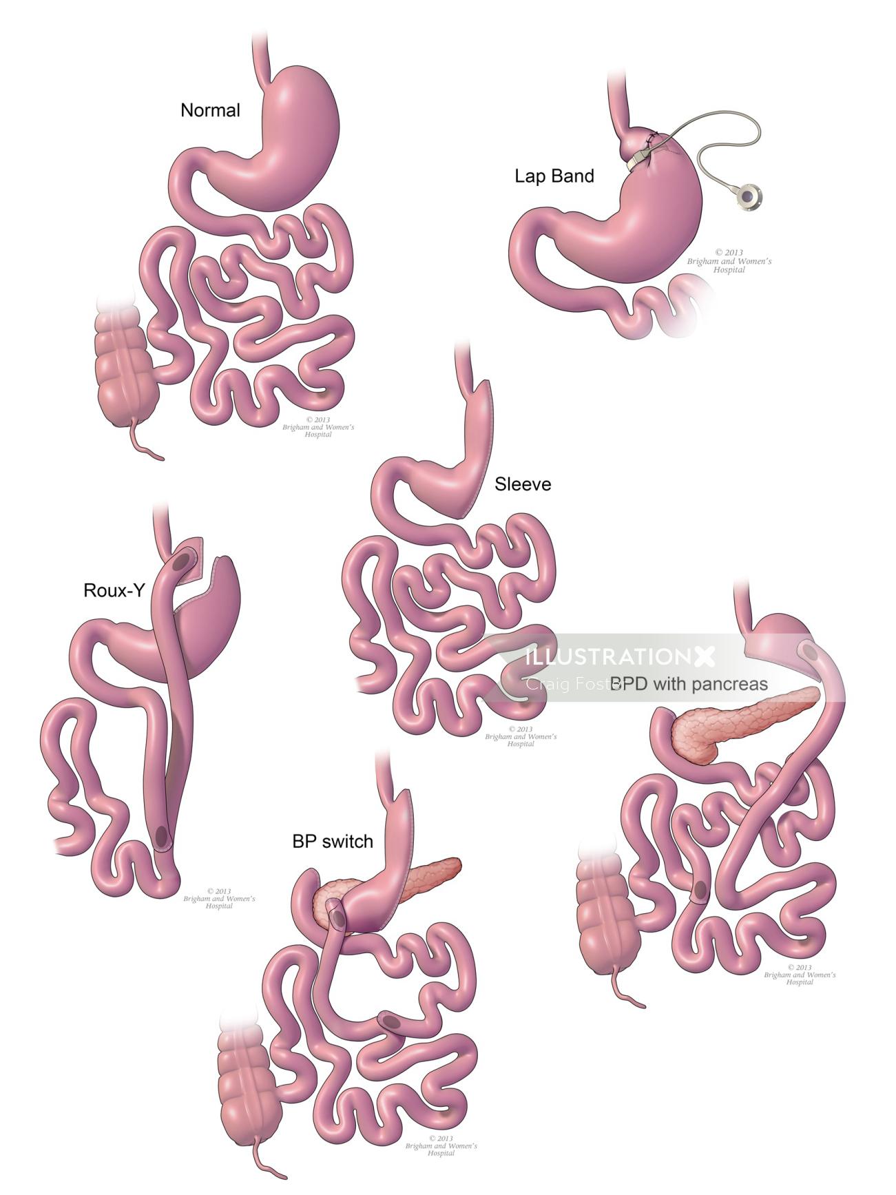 胃バイパスプロセスの図