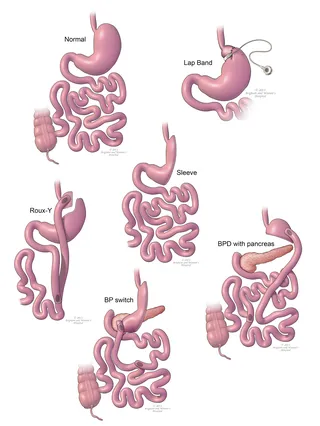 Uma ilustração do processo de bypass gástrico