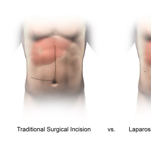 An illustration of incision comparison hr