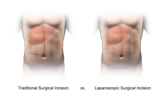 An illustration of incision comparison hr