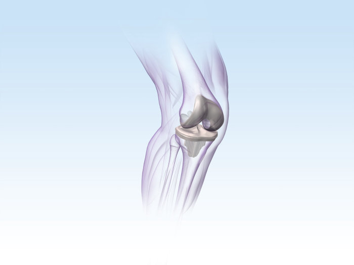 An illustration of KNEE implant hr