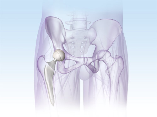 An illustration of PELVIS implant hr