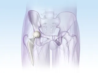 Uma ilustração do implante PELVIS hr