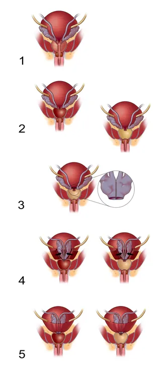 Uma ilustração do reparo da vesícula seminal hr