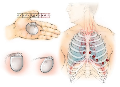 心电图，起搏器，心脏，肋骨，解剖结构，肺