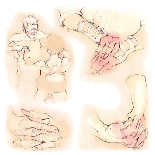 polyarthrite rhumatoïde, mains, articulations, patients, phalanges