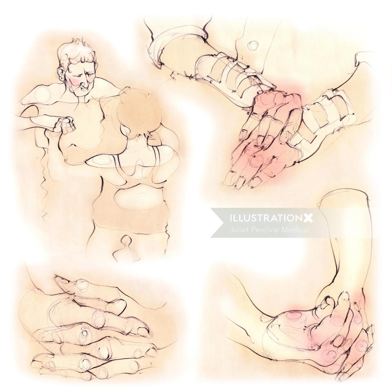 polyarthrite rhumatoïde, mains, articulations, patients, phalanges