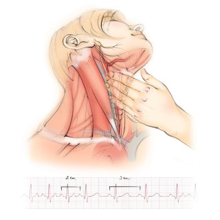masaje vagal, anatomía, seno carotídeo, nervio vago, arteria carótida, músculo esternocleidomastoideo