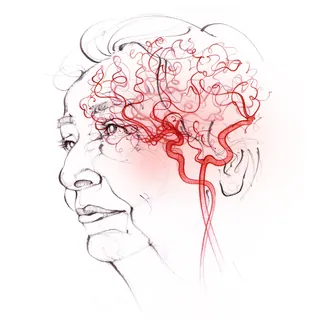 vascular dementia, anatomy, face, head, cerebral circulation