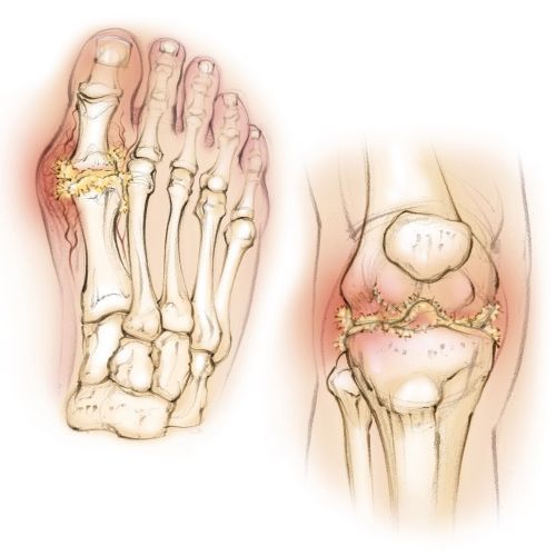 anatomy, gout, knee, foot, uric acid, bones, patella, tibia, fibula, inflammation