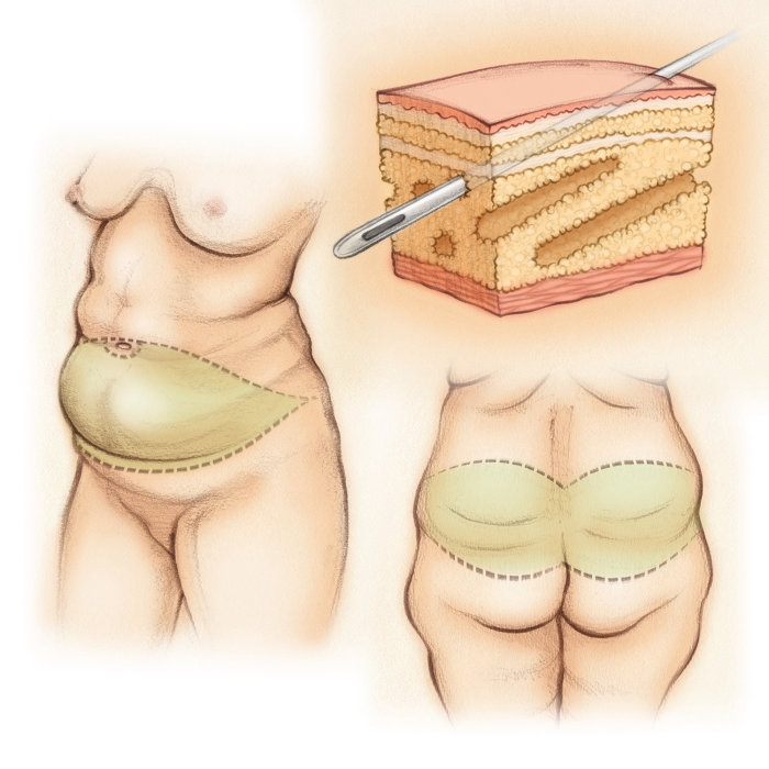 abdominoplastie, chirurgie esthétique, lifting du dos, graisse sous-cutanée