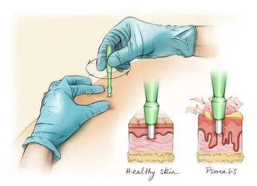 Punch biopsy of the skin for psoriasis