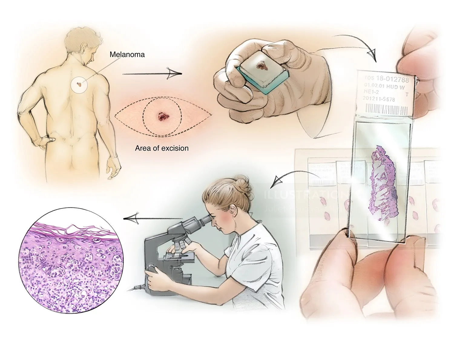 research, laboratory, histology, melanoma, microscope, clinician