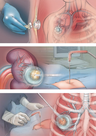 placement du port, tumeur du rein, ablation, tumeur du poumon, baguette d&#39;ablation thermique