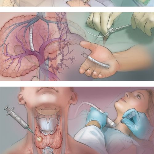 thyroid biopsy, tumour ablation, transjugular intrahepatic portosystemic shunt