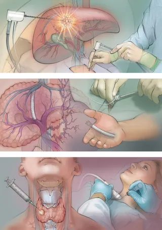 thyroid biopsy, tumour ablation, transjugular intrahepatic portosystemic shunt