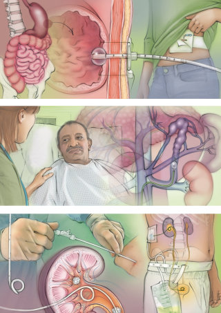 医疗、解剖学、BRTO、肾输尿管造口术、经皮胃造口管、患者、球囊支架