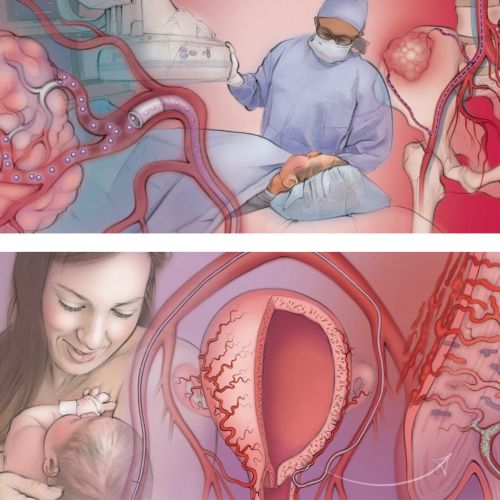 medical, peripheral artery disease, balloon stent, postpartum haemorrhage, baby, uterus, radiologist