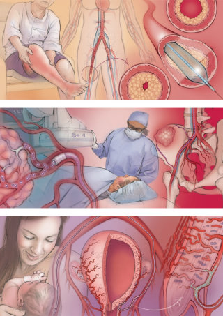 medical, peripheral artery disease, balloon stent, postpartum haemorrhage, baby, uterus, radiologist