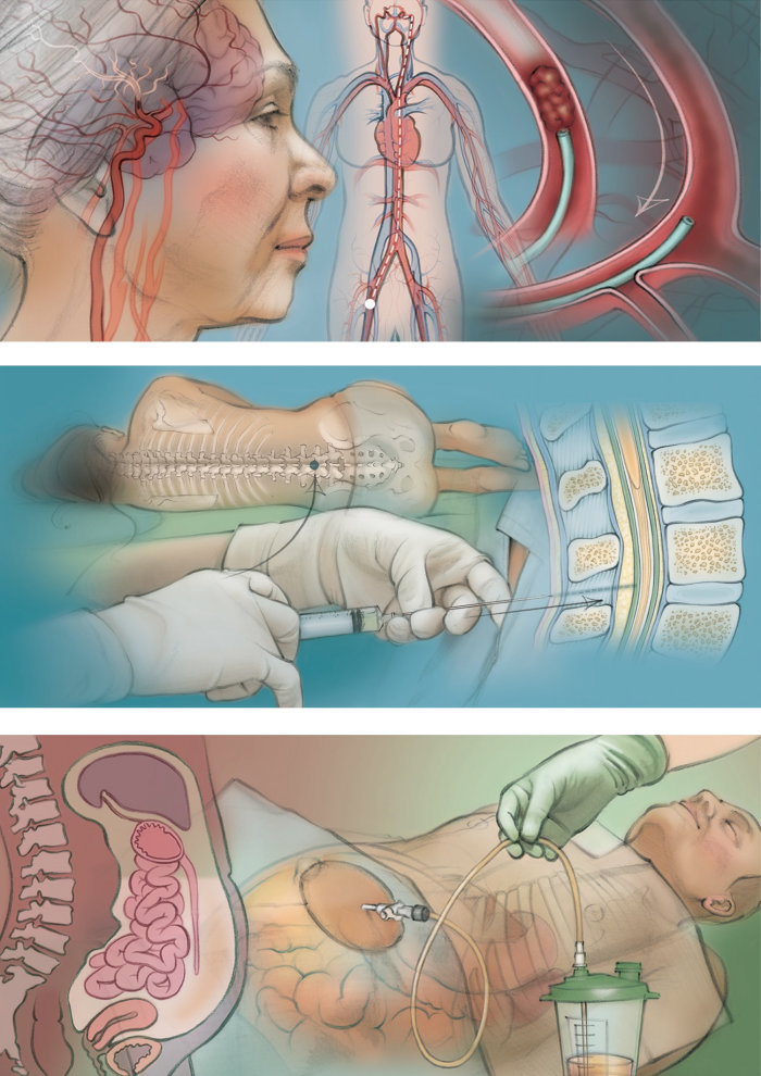 stroke, paracentesis, lumbar puncture, cerebral artery, medical, anatomy, patient