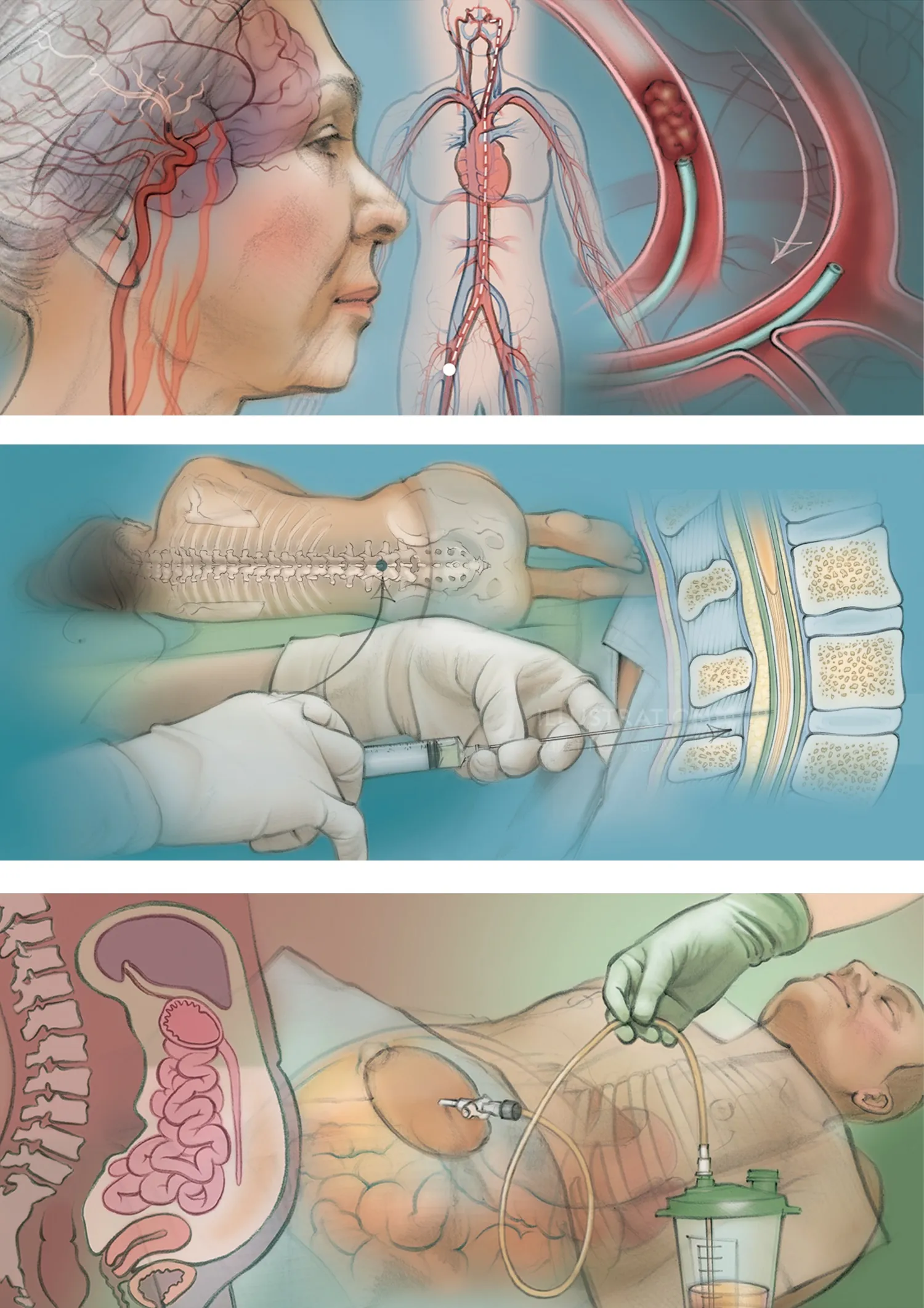 stroke, paracentesis, lumbar puncture, cerebral artery, medical, anatomy, patient