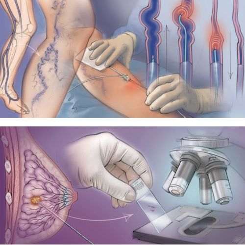 breast tumour, microscope, histology, vascular malformation, endogenous ablation, varicose vein