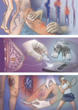 breast tumour, microscope, histology, vascular malformation, endogenous ablation, varicose vein