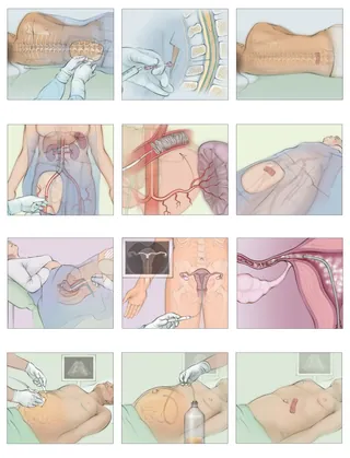 Medical illustrations showing minimally invasive image-guided procedures