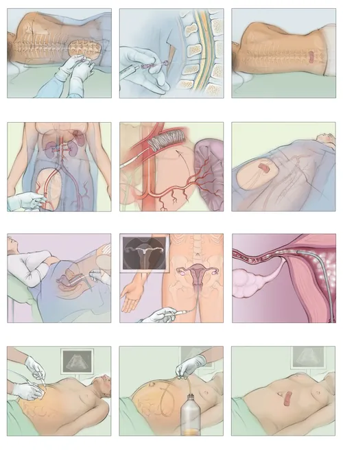 Medical illustrations showing minimally invasive image-guided procedures