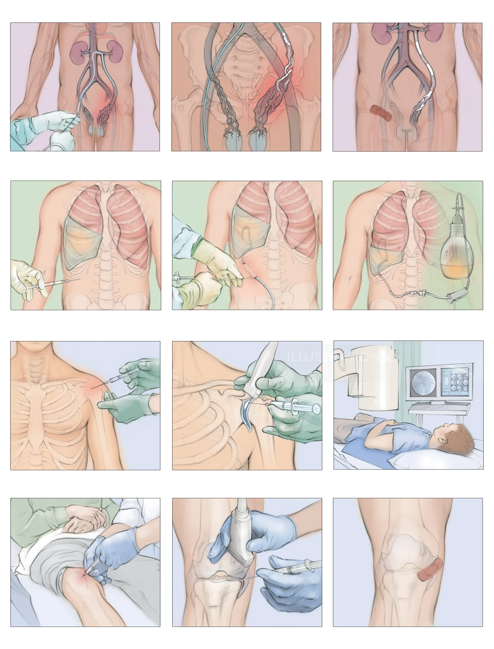 Medical illustrations showing minimally invasive procedures on the chest and knee