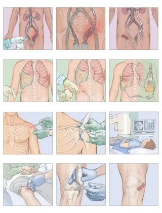 Medical illustrations showing minimally invasive procedures on the chest and knee