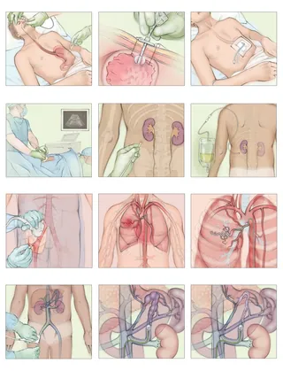 Medical illustration showing minimally invasive image-guided procedures