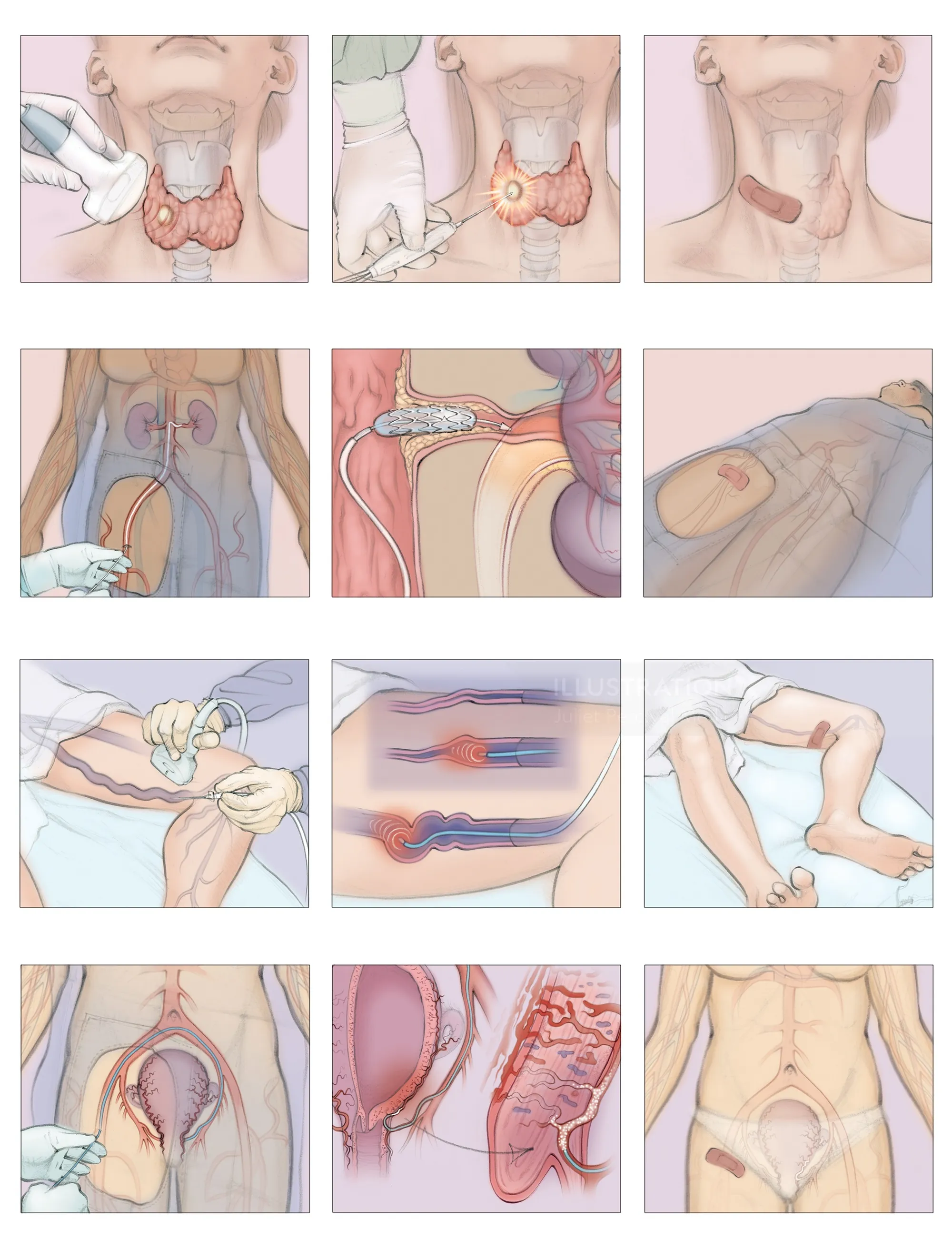 Medical illustrations showing various minimally invasive procedures on the human body