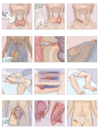 Medical illustrations showing various minimally invasive procedures on the human body