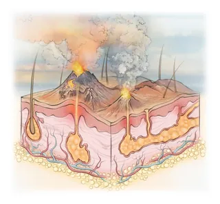 Illustration of hidradenitis suppurativa showing inflamed skin and hair follicles