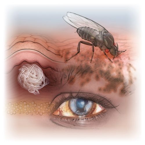 Illustration of onchocerciasis showing a fly, skin, and infected eye