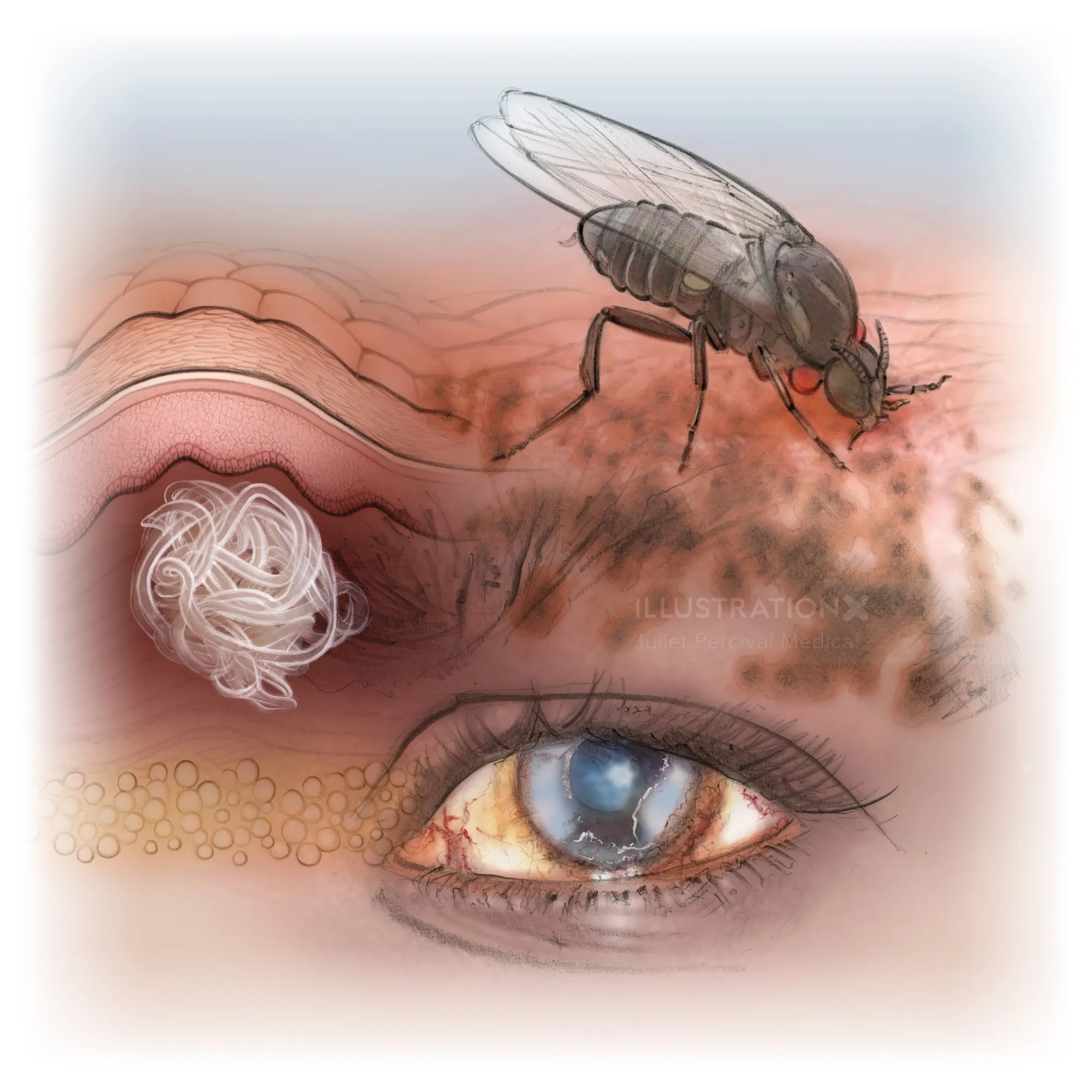 Illustration of onchocerciasis showing a fly, skin, and infected eye