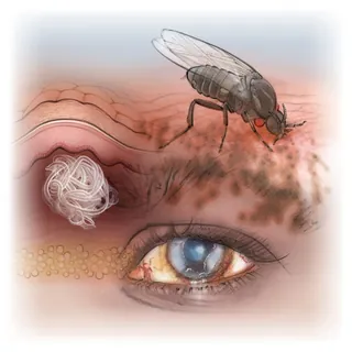 Illustration of onchocerciasis showing a fly, skin, and infected eye