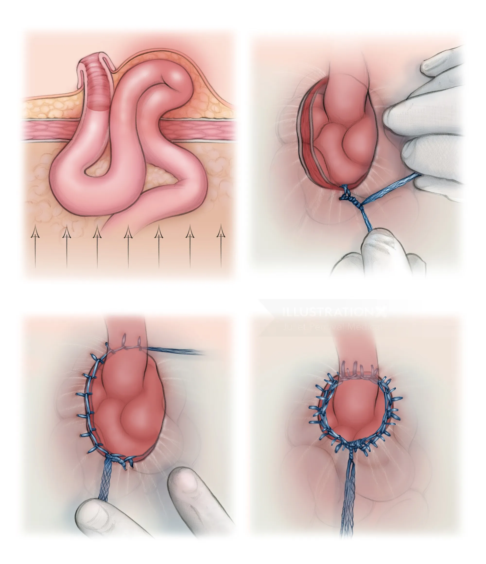 Step-by-step medical illustration of parastomal hernia repair using sutures