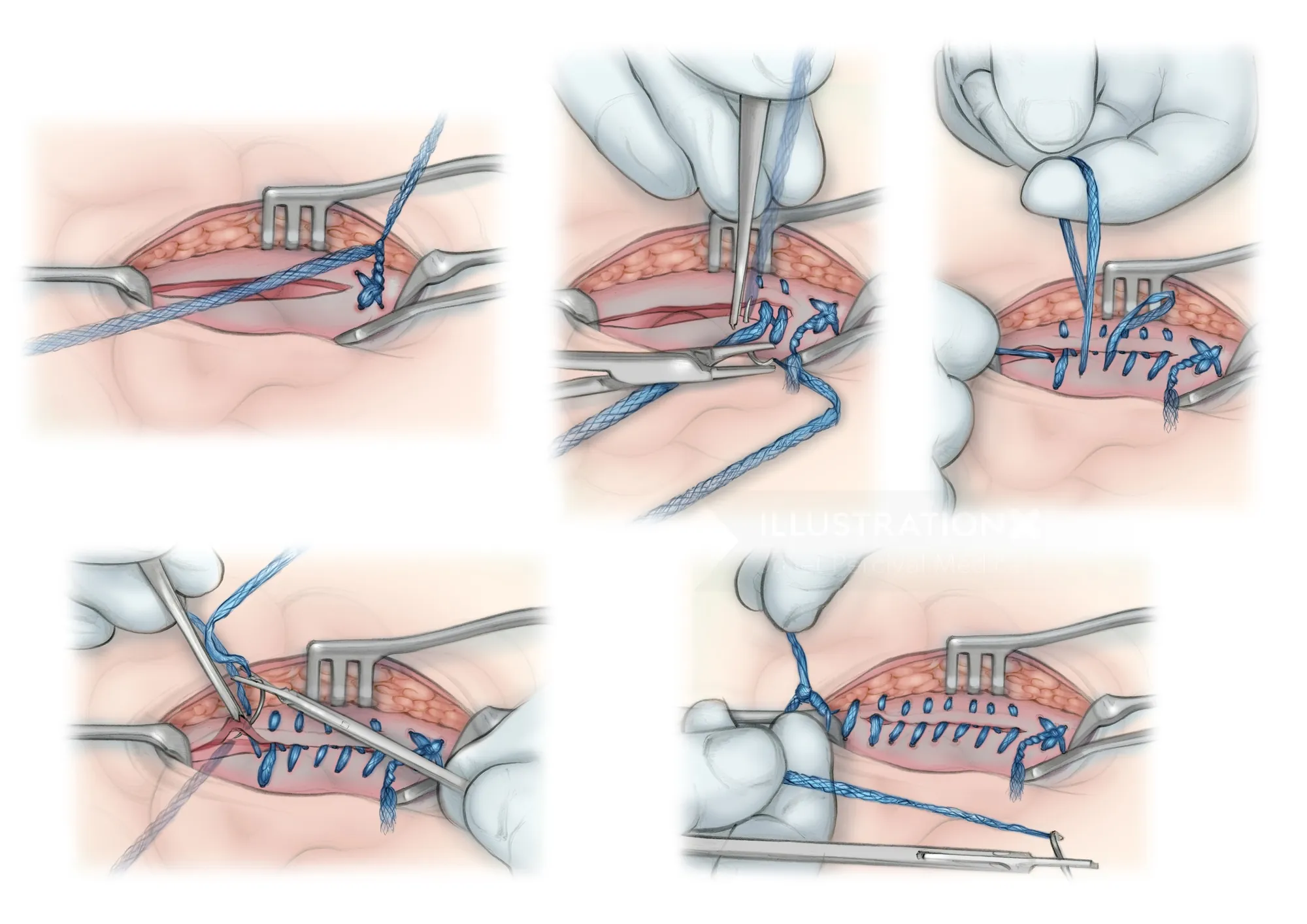 Step-by-step Duramesh hernia repair surgical illustration