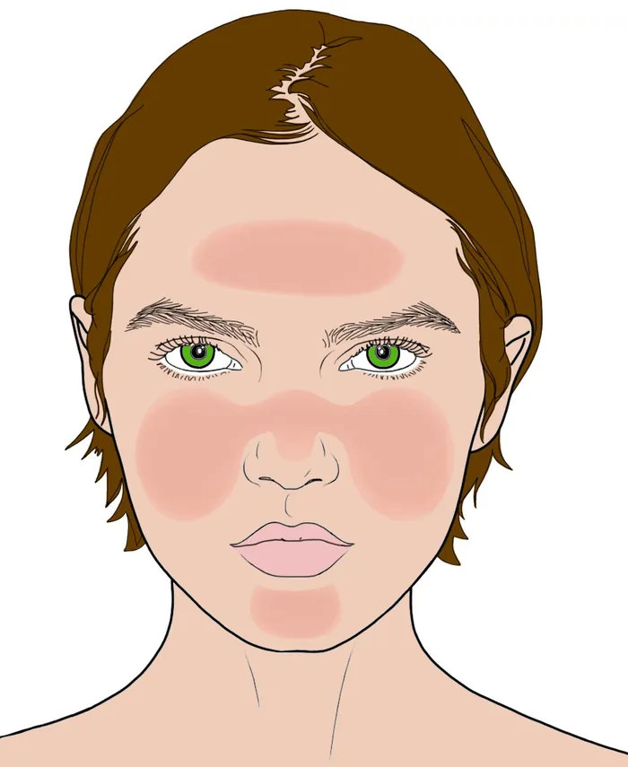 Face with red irritated skin patches on forehead, cheeks, and chin