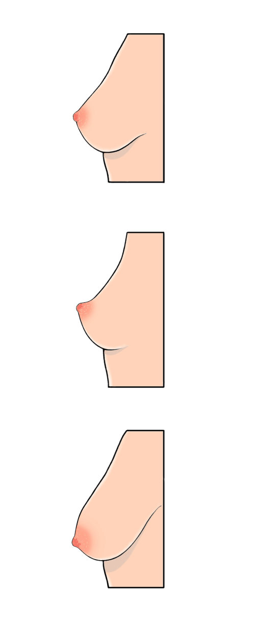 女人乳房的插图