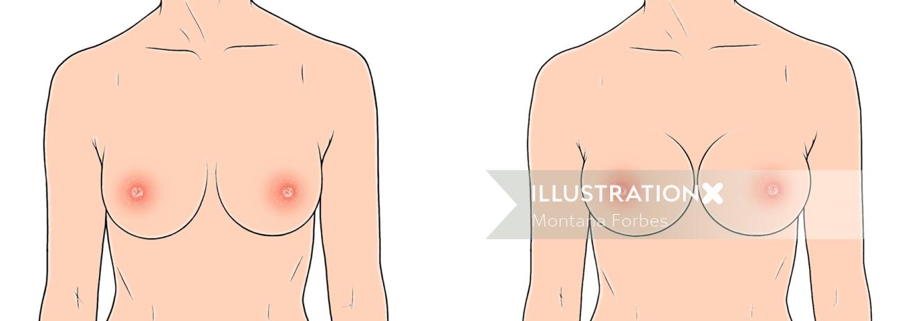 Medical illustration of swollen nipples

