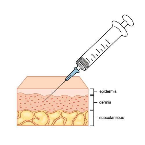 Injection to epidermis illustration by Montana Forbes