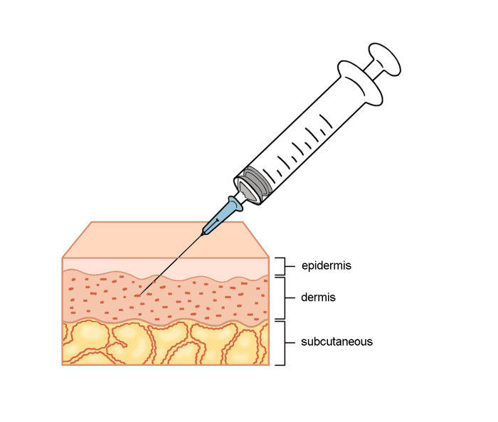 Injection to epidermis illustration by Montana Forbes